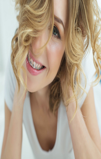 Orthodontie autoligaturante 1.jpg