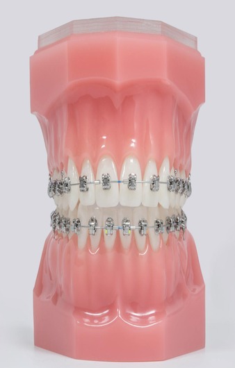 Orthodontie autoligaturante 2.jpeg