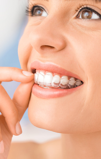 Orthodontie invisible 1 1.jpg