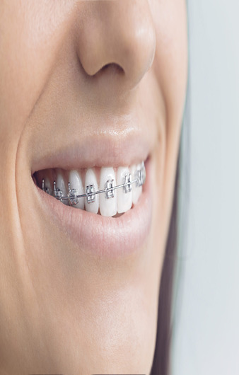 Orthodontie multi attaches 1.jpg