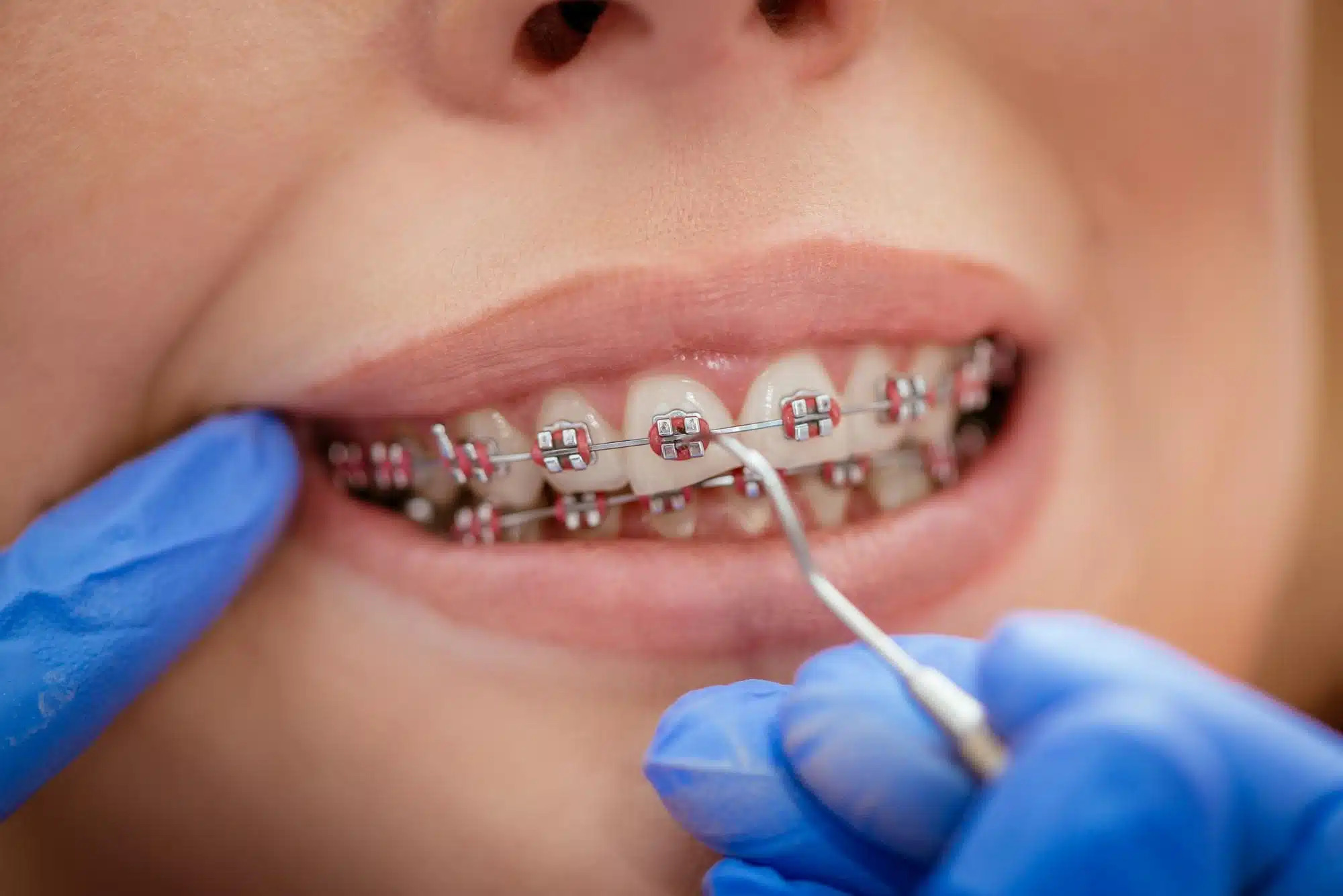 Orthodontie multi attaches 3.jpg